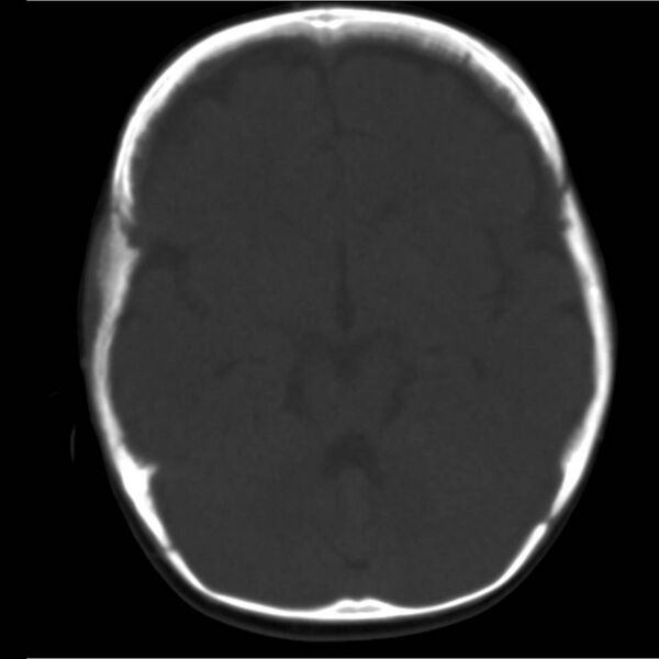 File:Neuroblastoma with skull metastases (Radiopaedia 30326-30958 Axial bone window 7).jpg