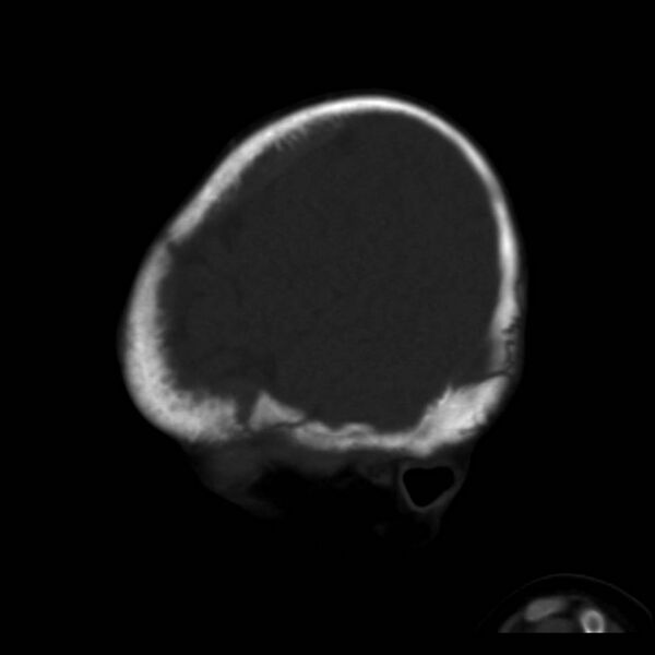 File:Neuroblastoma with skull metastases (Radiopaedia 30326-30958 Sagittal bone window 37).jpg