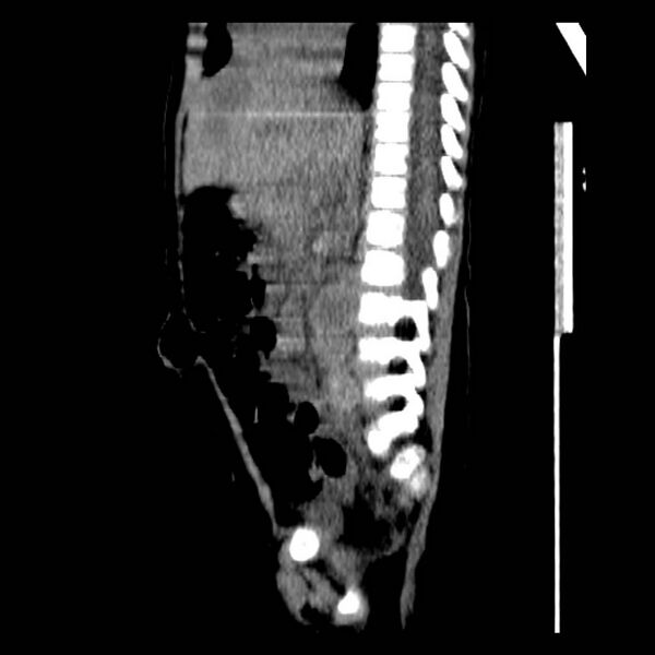 File:Neuroblastoma with skull metastases (Radiopaedia 30326-30960 B 24).jpg