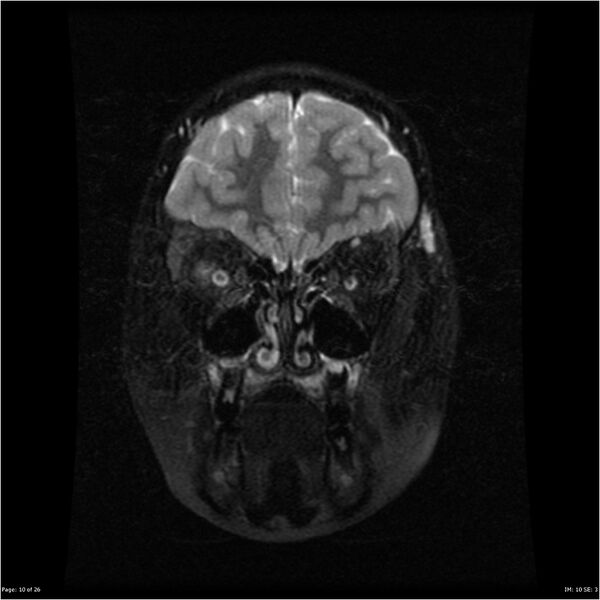 File:Neurofibromatosis type 1 (Radiopaedia 22541-22564 C 10).jpg