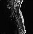Neurofibromatosis type 2 - cranial and spinal involvement (Radiopaedia 5351-7112 Sagittal T2 1).jpg