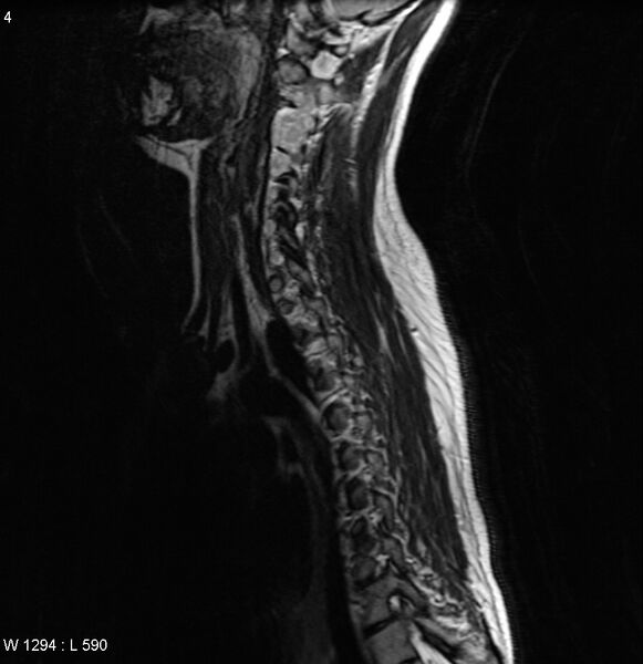 File:Neurofibromatosis type 2 - cranial and spinal involvement (Radiopaedia 5351-7112 Sagittal T2 1).jpg