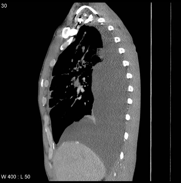 File:Non-Hodgkin lymphoma involving lung (Radiopaedia 29094-29470 D 21).jpg