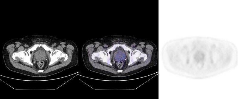 File:Non-Hodgkin lymphoma involving seminal vesicles with development of interstitial pneumonitis during Rituximab therapy (Radiopaedia 32703-33752 ax CT Fus PET 61).jpg