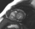 Non-compaction of the left ventricle (Radiopaedia 69436-79314 Short axis cine 59).jpg