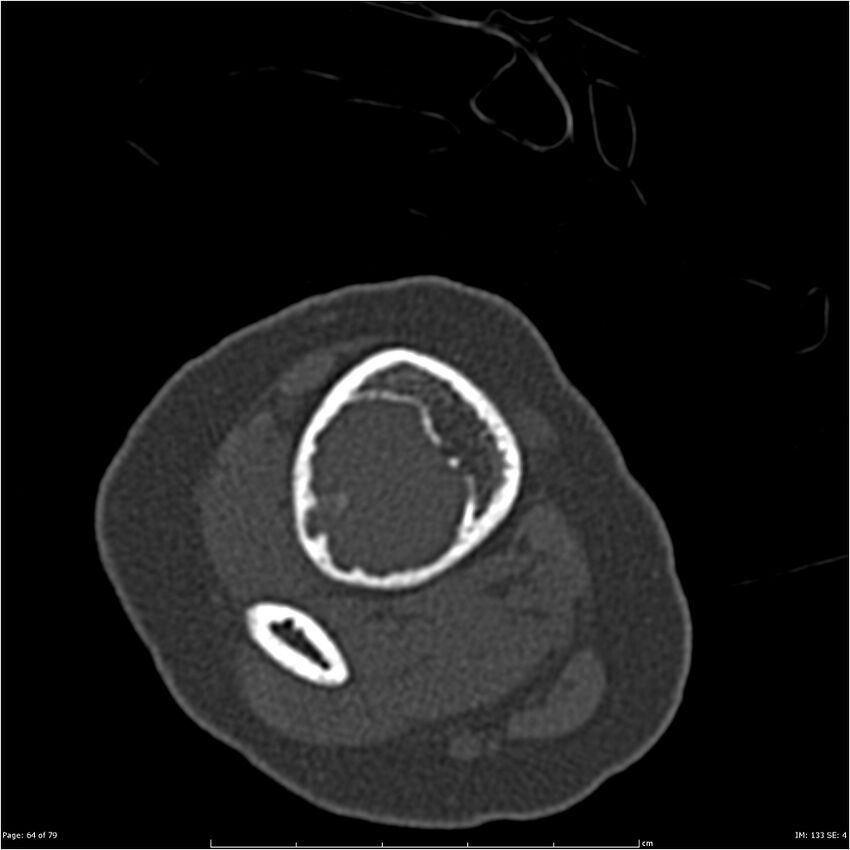 Non-ossifying fibroma (Radiopaedia 23651-23780 bone window 64).jpg