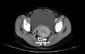 Non-puerperal uterine inversion (Radiopaedia 78343-91094 A 35).jpg
