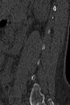 Normal CT lumbar spine (Radiopaedia 53981-60118 Sagittal bone window 79).jpg