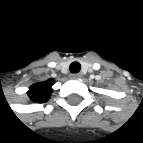 File:Normal CT of the neck (Radiopaedia 14575-14500 Axial C+ 56).jpg
