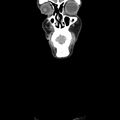 Normal CT of the neck (Radiopaedia 14575-14500 Coronal C+ 4).jpg