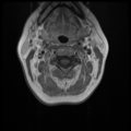 Normal cervical and thoracic spine MRI (Radiopaedia 35630-37156 Axial T1 C+ 25).png