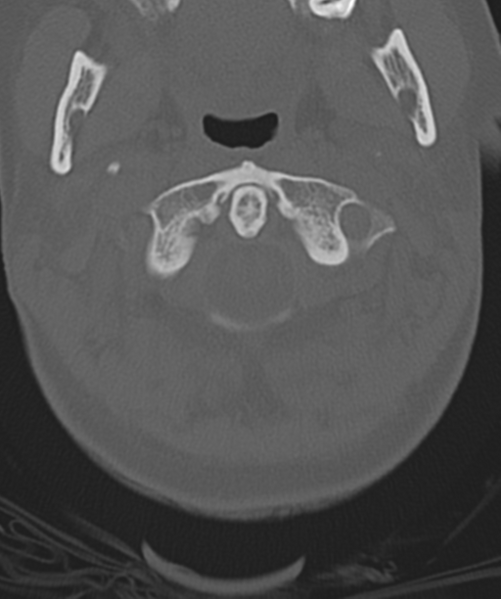 File:Normal cervical spine MRI (including Dixon) (Radiopaedia 42762-45926 Axial bone window 11).png