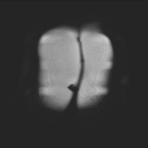 File:Normal liver MRI with Gadolinium (Radiopaedia 58913-66163 Coronal T2 1).jpg