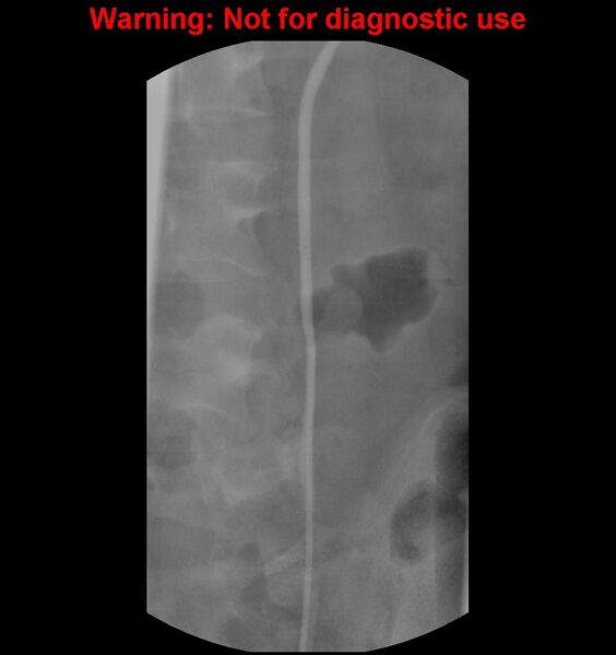 File:Normal retrograde pyelography of a native and transplant kidney (Radiopaedia 40480-43054 Native kidney 12).jpg