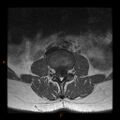Normal spine MRI (Radiopaedia 77323-89408 Axial T1 7).jpg