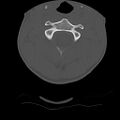 Normal trauma spine imaging (age 16) (Radiopaedia 45335-49358 Axial bone window 20).jpg