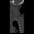Occipital condyle fracture (Radiopaedia 31755-32691 Sagittal bone window 1).jpg