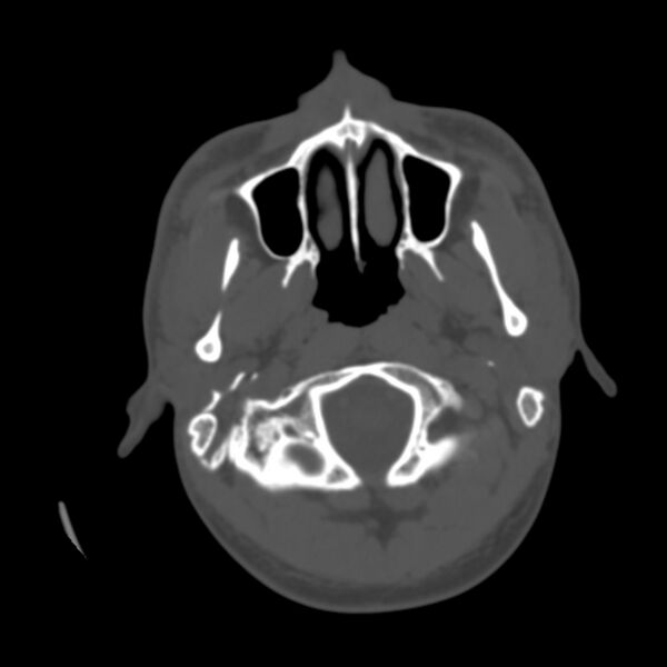 File:Occipital spur - asymptomatic (Radiopaedia 87753-104201 Axial bone window 2).jpg