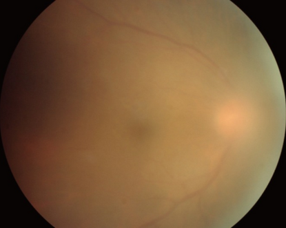 Infection of the vitreous body in toxoplasmosis of the eye