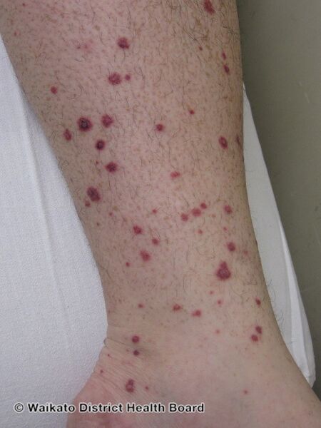 File:Palpable purpura (DermNet NZ granulomatosis-polyangiitis-6).jpg