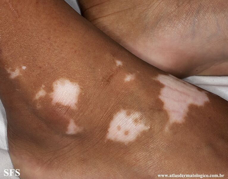 File:Vitiligo (Dermatology Atlas 49).jpg
