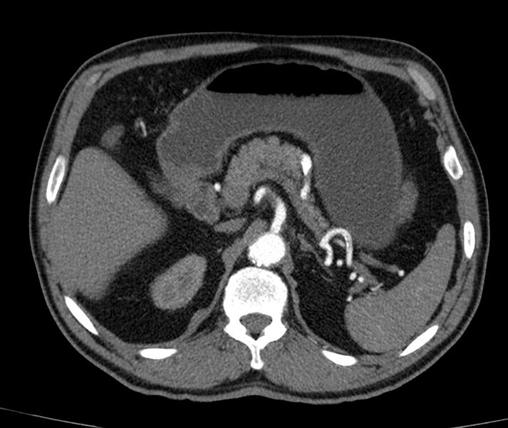 File:Abdominal aortic aneurysm (Radiopaedia 22421-22458 C+ arterial phase 16).jpg