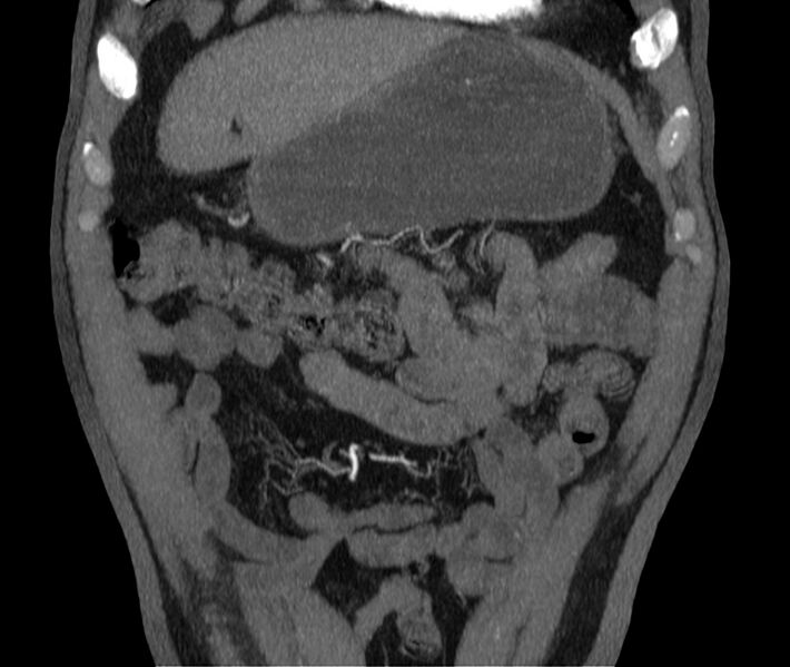File:Abdominal aortic aneurysm (Radiopaedia 22421-22458 C 1).jpg
