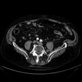 Abdominal aortic aneurysm (Radiopaedia 25855-26001 Axial C+ arterial phase 92).jpg