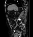 Abdominal aortic aneurysm (Radiopaedia 25855-26001 Sagittal C+ arterial phase 9).jpg