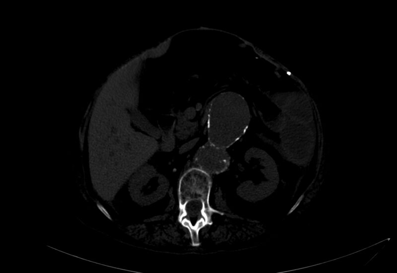 File:Abdominal aortic aneurysm - impending rupture (Radiopaedia 19233-19246 B 1).jpg
