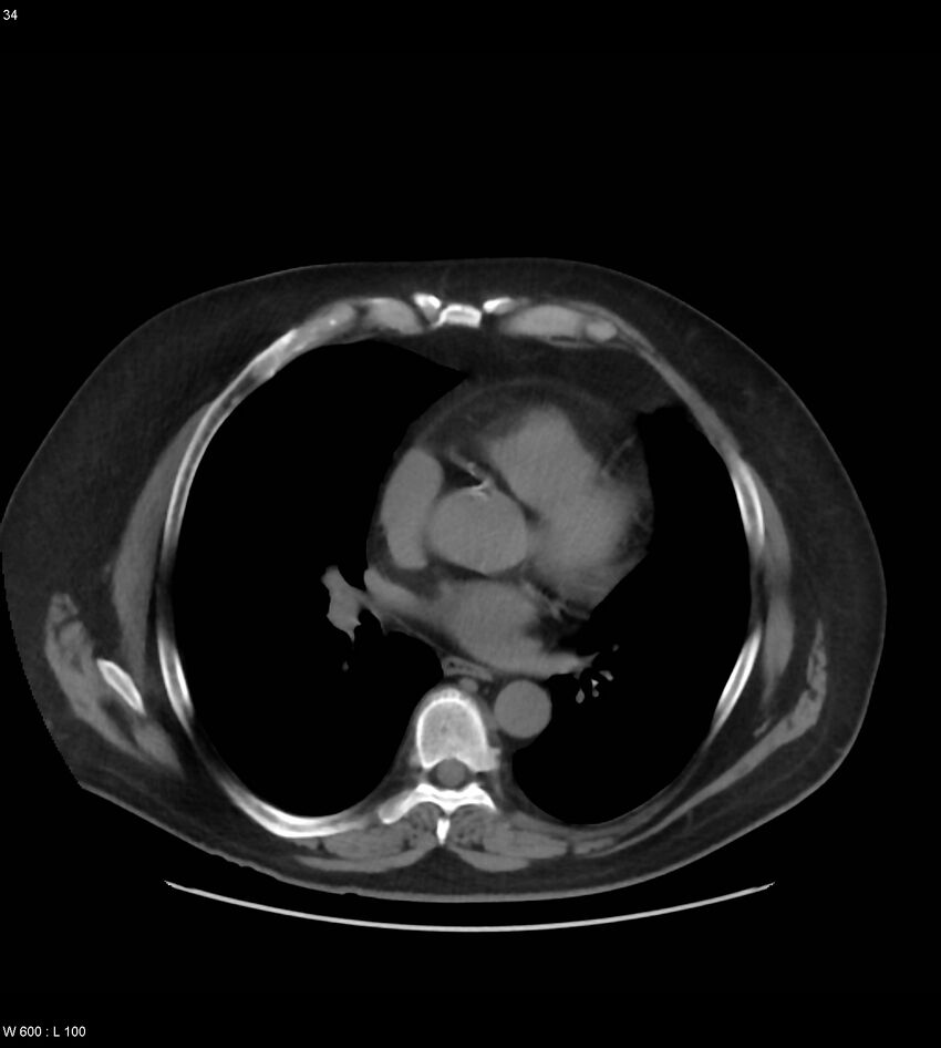 Abdominal aortic aneurysm with intramural hematoma then rupture (Radiopaedia 50278-55631 Axial non-contrast 30).jpg