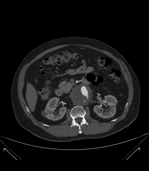 File:Abdominal aortic aneurysm with thrombus fissuration (Radiopaedia 46218-50618 Axial C+ arterial phase 15).jpg
