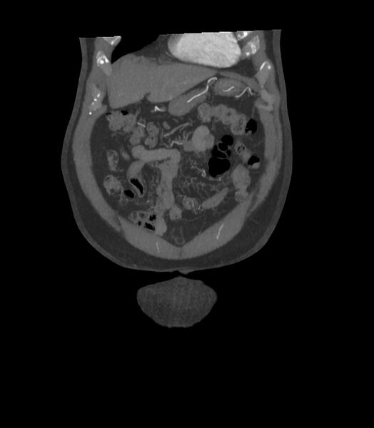 File:Abdominal aortic aneurysm with thrombus fissuration (Radiopaedia 46218-50618 Coronal C+ arterial phase 36).jpg