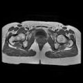 Abdominal wall endometriosis (Radiopaedia 83702-98847 Axial T1 16).jpg