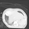 Aberrant left pulmonary artery (pulmonary sling) (Radiopaedia 42323-45435 Axial lung window 33).jpg