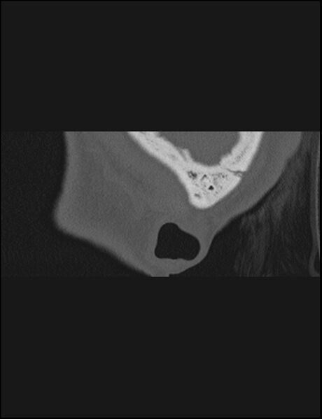 File:Aberrant right internal carotid artery (Radiopaedia 65191-74198 Sagittal non-contrast 6).jpg