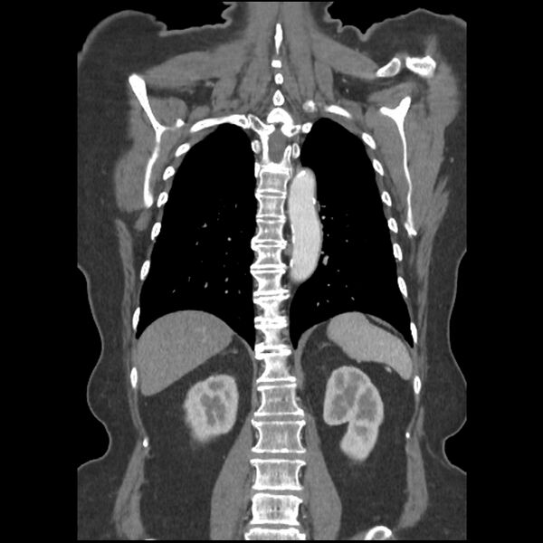 File:Aberrant right subclavian and left vertebral arteries (Radiopaedia 43467-46847 Coronal C+ portal venous phase 64).jpg