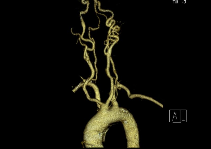 File:Aberrant right subclavian artery (Radiopaedia 19283-19294 3D reconstruction C+ arterial phase 9).jpg