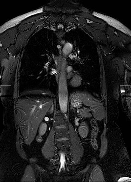 File:Aberrant right subclavian artery with background Takayasu arteritis (Radiopaedia 21423-21363 Coronal MRA 20).jpg