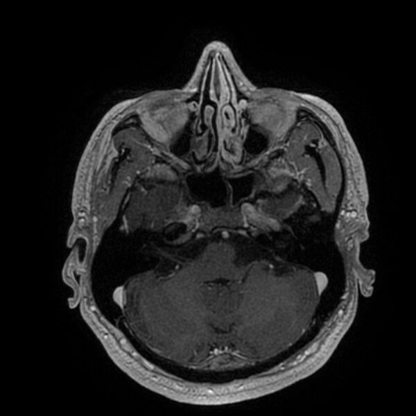 File:Acoustic schwannoma - intracanalicular (Radiopaedia 37247-39024 Axial T1 C+ 65).jpg