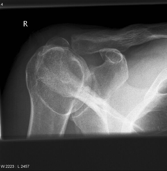 File:Acromion fracture (Radiopaedia 12284-12581 D 1).jpg