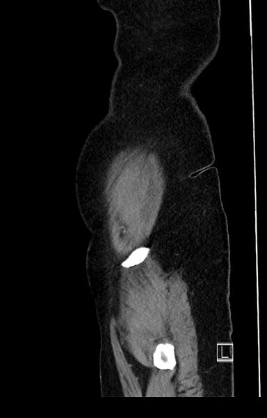 File:Active Crohn disease (Radiopaedia 59394-66750 Sagittal C+ portal venous phase 4).jpg