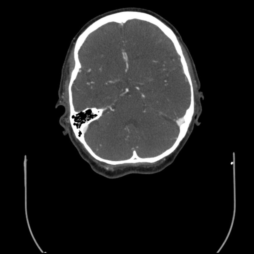 Acute M1 occlusion with ischemic penumbra (CT perfusion) (Radiopaedia 71897-82344 Axial C+ arterial phase thins 87).jpg