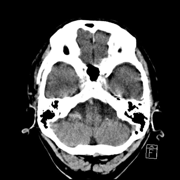 File:Acute P1 occlusion with PCA ischemia penumbra (CT perfusion) (Radiopaedia 72084-82586 Axial non-contrast 8).jpg