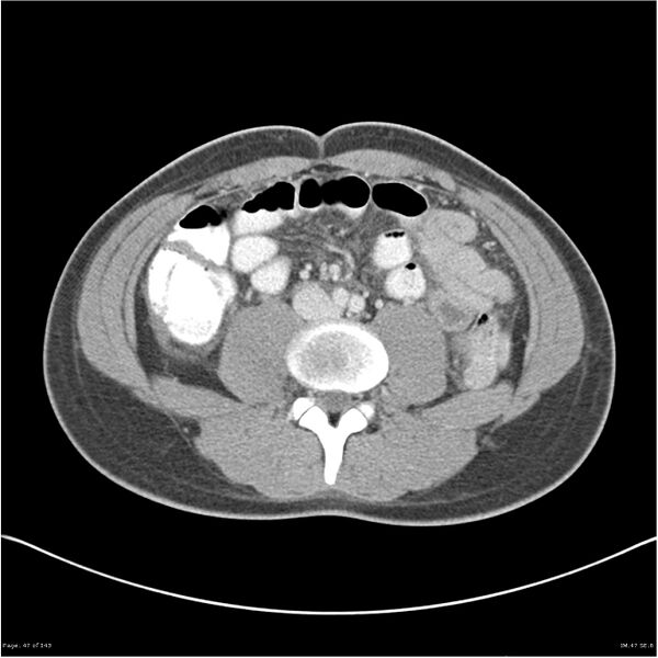 File:Acute appendicitis (Radiopaedia 25364-25615 B 37).jpg