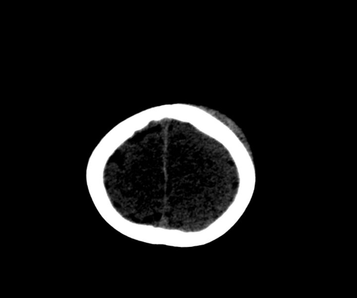 File:Acute epidural hematoma (Radiopaedia 63659-72335 Axial subdural window 21).jpg