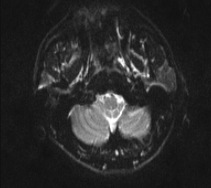 File:Acute ischemic stroke - posterior circulation territory (Radiopaedia 77670-89880 Axial DWI 3).jpg