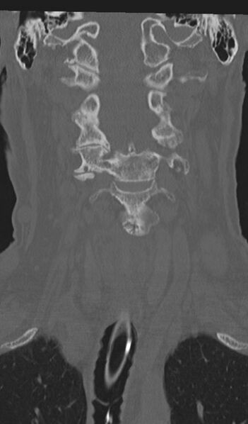 File:Acute on chronic subdural hematoma and thoracic vertebral injury in a multitrauma patient (Radiopaedia 31698-32619 Coronal bone window 20).jpg