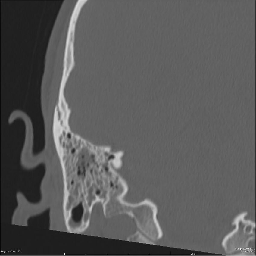 Acute otomastoiditis (Radiopaedia 28276-28512 Coronal PTB bone window reformat 46).jpg