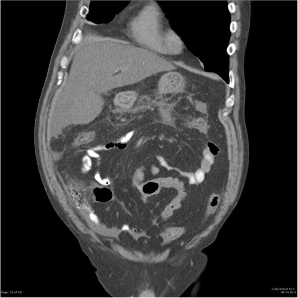 File:Acute pancreatitis (Radiopaedia 19135-19116 Coronal non-contrast 9).jpg
